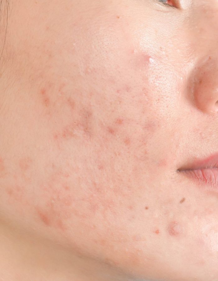 Acne-Scar-treatment-at-Dr-Manisha-Chopra-clinic